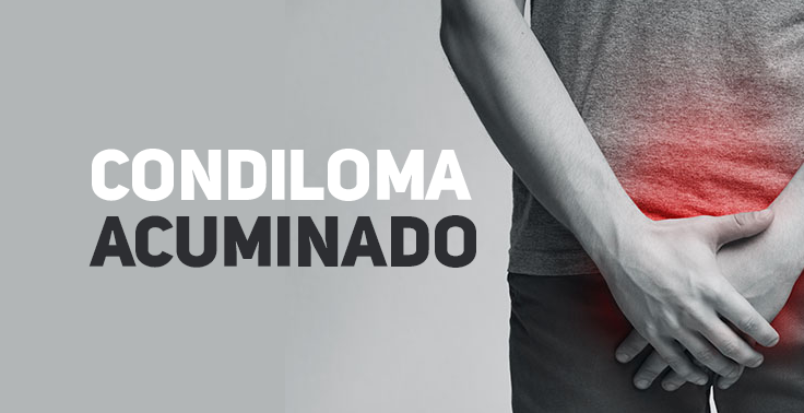 Imagem em tons de cinza mostrando uma pessoa da cintura para baixo, com as mãos cobrindo a região genital. Há um destaque vermelho indicando desconforto ou inflamação na área íntima. À esquerda, aparece o texto em destaque: 'CONDILOMA ACUMINADO'.